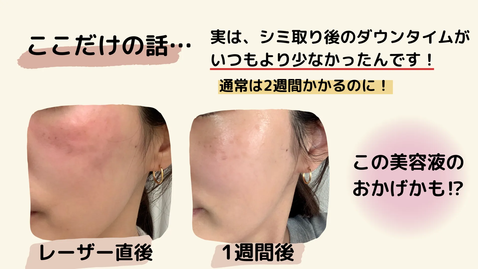 ここだけの話・・実はシミ取り後のダウンタイムがいつもより少なかったんです!通常は2週間かかるのに!この美容液のおかげかも!?レーザー直後 1週間後