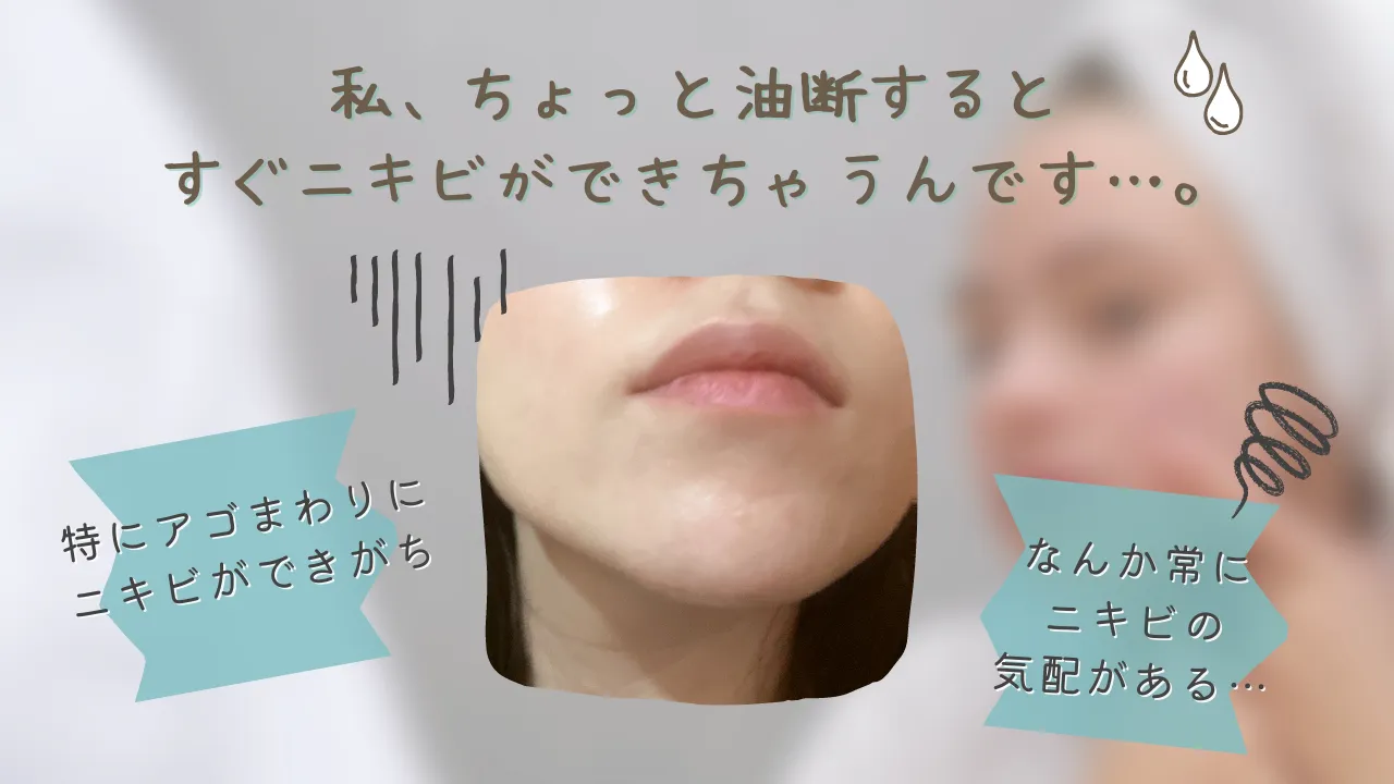 私、ちょっと油断するとすぐニキビができちゃうんです…・・。なんか常にニキビの気配がある...特にアゴまわりにニキビができがち