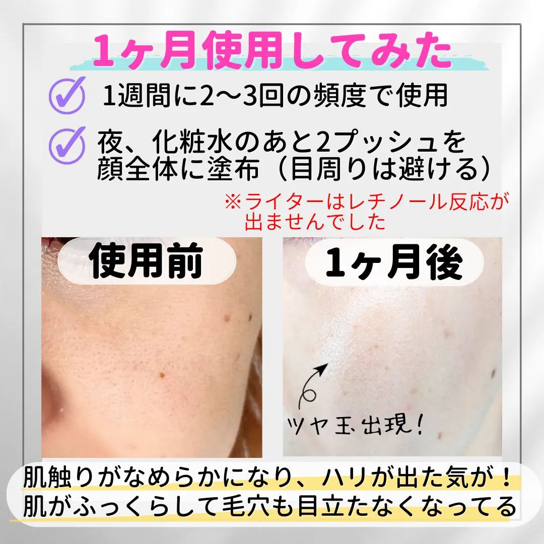 1ヶ月使用してみた1週間に2~3回の頻度で使用夜、化粧水のあと2プッシュを 顔全体に塗布 (目周りは避ける)※ライターはレチノール反応が出ませんでした使用前1ヶ月後ツヤ玉出現!肌触りがなめらかになり、ハリが出た気が! 肌がふっくらして毛穴も目立たなくなってる